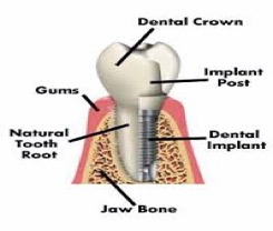 Dental Implants